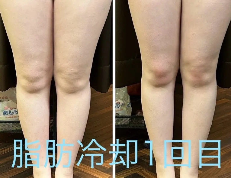 脂肪冷却